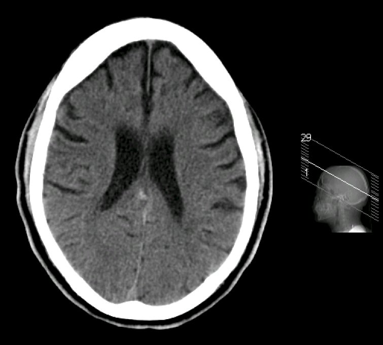 CT lateral ventricles